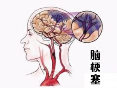 養(yǎng)成好的生活習(xí)慣，能夠有效預(yù)防腦梗塞